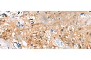 Immunohistochemistry of paraffin-embedded Human esophagus cancer tissue using CBR3 Polyclonal Antibody at dilution of 1:35(x200)
