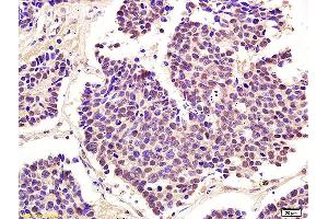 Formalin-fixed and paraffin embedded human lung carcinoma labeled with Anti-Phospho-cdc2 (Thr161) Polyclonal Antibody, Unconjugated (ABIN746978) at 1:200 followed by conjugation to the secondary antibody and DAB staining (CDK1 antibody  (pThr161))