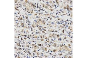 Immunohistochemistry of paraffin-embedded human gastric cancer using SNRPE Antibody. (SNRPE antibody  (AA 1-92))