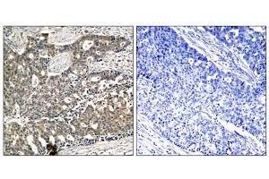 Immunohistochemical analysis of paraffin- embedded human breast carcinoma tissue, using p56Dok-2 (phospho-Tyr299) antibody (E011278). (DOK2 antibody  (pTyr299))