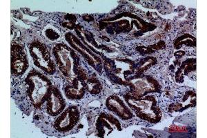 Immunohistochemistry (IHC) analysis of paraffin-embedded Human Prostate Cancer, antibody was diluted at 1:100. (LY9 antibody  (Internal Region))
