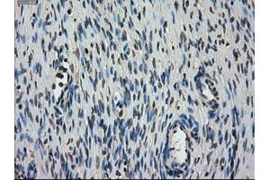 Immunohistochemical staining of paraffin-embedded Carcinoma of lung tissue using anti-STK39mouse monoclonal antibody. (STK39 antibody)