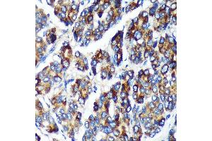 Immunohistochemistry of paraffin-embedded Human liver cancer using PLEKHB2 Rabbit pAb (ABIN7269415) at dilution of 1:100 (40x lens). (PLEKHB2 antibody  (AA 1-222))