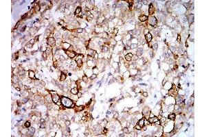Immunohistochemical analysis of paraffin-embedded breast cancer tissues using PGRMC1 mouse mAb with DAB staining.