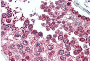 Human Brain, Cortex (formalin-fixed, paraffin-embedded) stained with SOD2 antibody ABIN396955 at 1:50 followed by biotinylated anti-mouse IgG secondary antibody ABIN481714, alkaline phosphatase-streptavidin and chromogen. (SOD2 antibody)