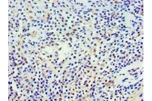 Immunohistochemistry of paraffin-embedded human breast cancer using ABIN7161360 at dilution of 1:100 (NCS1 antibody  (AA 1-190))