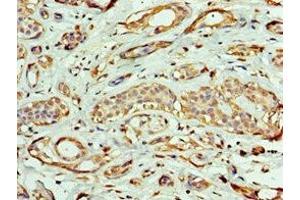 Immunohistochemistry of paraffin-embedded human breast cancer using ABIN7161953 at dilution of 1:100