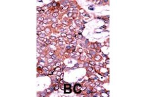 Formalin-fixed and paraffin-embedded human cancer tissue reacted with the primary antibody, which was peroxidase-conjugated to the secondary antibody, followed by AEC staining. (CDC25A antibody  (pSer75))