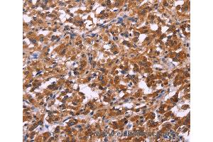 Immunohistochemistry of Human cervical cancer using SPATA7 Polyclonal Antibody at dilution of 1:30