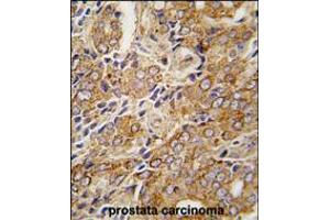 Formalin-fixed and paraffin-embedded human prostata carcinoma tissue reacted with , which was peroxidase-conjugated to the secondary antibody, followed by DAB staining. (TRPM8 antibody  (C-Term))