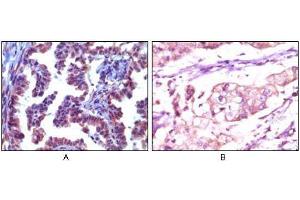 Immunohistochemical analysis of paraffin-embedded human metastatic adenocarcinoma(A) and stomach adenocarcinoma (B), showing cytoplasmic localization using Trim5α mouse mAb with AEC staining (A) and DAB staining(B). (TRIM5 antibody)