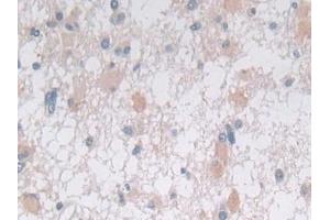 Detection of STX2 in Human Glioma Tissue using Polyclonal Antibody to Syntaxin 2 (STX2) (STX2 antibody  (AA 8-262))