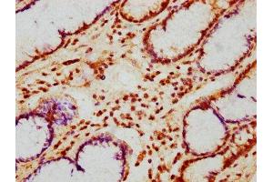 IHC image of ABIN7163675 diluted at 1:200 and staining in paraffin-embedded human gastric cancer performed on a Leica BondTM system.