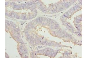 Immunohistochemistry of paraffin-embedded human endometrial cancer using ABIN7167001 at dilution of 1:100 (RABGEF1 antibody  (AA 1-491))