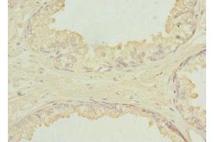 Immunohistochemistry of paraffin-embedded human prostate cancer using ABIN7151649 at dilution of 1:100 (SH3GLB2 antibody  (AA 1-250))