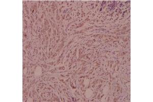 Immunohistochemistry (IHC) analyzes of CD124 / IL4R Antibody in paraffin-embedded human breast carcinoma tissue at 1/100. (IL4 Receptor antibody)