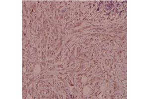 Immunohistochemistry (IHC) analyzes of CD124 / IL4R Antibody in paraffin-embedded human breast carcinoma tissue at 1/100. (IL4 Receptor antibody)