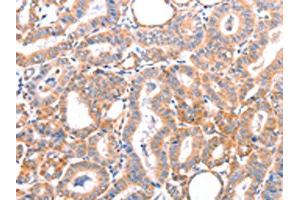 The image on the left is immunohistochemistry of paraffin-embedded Human thyroid cancer tissue using ABIN7128444(AOC1 Antibody) at dilution 1/15, on the right is treated with fusion protein. (DAO antibody)