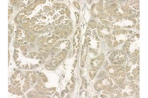 ABIN6266307 and ABIN6277426 at 1/100 staining human renal cell carcinoma by IHC-P. (PIBF1 antibody  (C-Term))