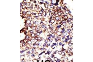 Formalin-fixed and paraffin-embedded human cancer tissue reacted with the primary antibody, which was peroxidase-conjugated to the secondary antibody, followed by DAB staining. (GCNT1 antibody  (AA 88-117))