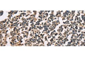 Immunohistochemistry of paraffin-embedded Human tonsil tissue using ZFYVE19 Polyclonal Antibody at dilution of 1:60(x200) (ZFYVE19 antibody)