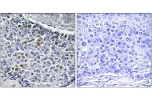Immunohistochemistry analysis of paraffin-embedded human breast carcinoma, using MAD1 (Phospho-Ser428) Antibody. (PSMD14 antibody  (pSer428))