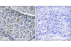 Immunohistochemistry analysis of paraffin-embedded human breast carcinoma, using MAD1 (Phospho-Ser428) Antibody. (PSMD14 antibody  (pSer428))