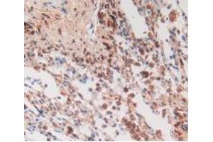 IHC-P analysis of Human Lung Cancer Tissue, with DAB staining. (Cytohesin 1 antibody  (AA 1-398))