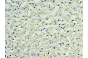 Immunohistochemistry of paraffin-embedded human liver cancer using ABIN7167852 at dilution of 1:100 (RBP4 antibody  (AA 19-201))