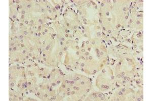 Immunohistochemistry of paraffin-embedded human gastric cancer using ABIN7174864 at dilution of 1:100 (C6orf141 antibody  (AA 1-237))