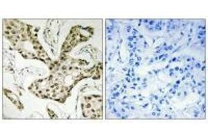 Immunohistochemistry analysis of paraffin-embedded human liver carcinoma tissue using TOP2A antibody. (Topoisomerase II alpha antibody  (N-Term))