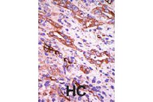 Formalin-fixed and paraffin-embedded human hepatocellular carcinoma tissue reacted with GRK1 polyclonal antibody  , which was peroxidase-conjugated to the secondary antibody, followed by DAB staining . (GRK1 antibody  (C-Term))