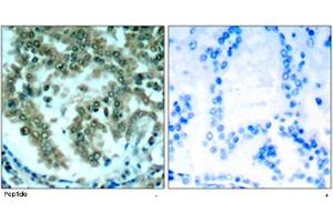Immunohistochemical analysis of paraffin-embedded human lung carcinoma tissue using PRKCQ polyclonal antibody .