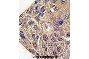 Formalin-fixed and paraffin-embedded human lung carcinomareacted with YARS polyclonal antibody , which was peroxidase-conjugated to the secondary antibody, followed by AEC staining.