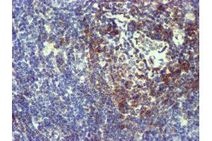 Immunohistochemical staining of paraffin-embedded Human lymphoma tissue using anti-NMT2 mouse monoclonal antibody. (NMT2 antibody)