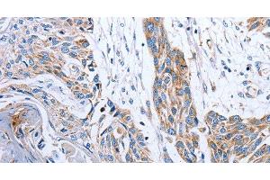 Immunohistochemistry of paraffin-embedded Human esophagus cancer tissue using NDUFA12 Polyclonal Antibody at dilution 1:50 (NDUFA12 antibody)