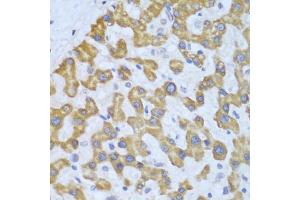 Immunohistochemistry of paraffin-embedded human liver cancer using PRKCD antibody (ABIN5974435) at dilution of 1/100 (40x lens). (PKC delta antibody)