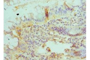 Immunohistochemistry of paraffin-embedded human colon cancer using ABIN7145627 at dilution of 1:100 (BLMH antibody  (AA 1-300))