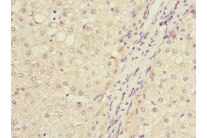 Immunohistochemistry of paraffin-embedded human liver cancer using ABIN7165661 at dilution of 1:100 (IWS1 antibody  (AA 570-819))