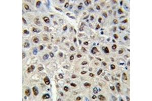 IHC analysis of FFPE human hepatocarcinoma stained with SS-B antibody (SSB antibody  (AA 366-397))