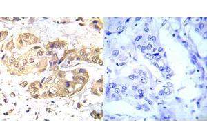 Immunohistochemical analysis of paraffin- embedded human breast carcinoma tissue using LKB1 (Ab-428) antibody (E022046). (LKB1 antibody)