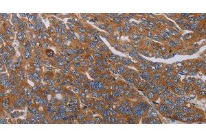 Immunohistochemistry of paraffin-embedded Human ovarian cancer tissue using PARP10 Polyclonal Antibody at dilution 1:30 (PARP10 antibody)