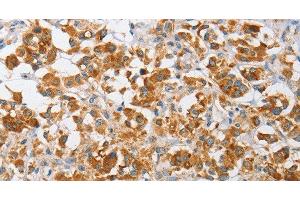 Immunohistochemistry of paraffin-embedded Human thyroid cancer using ARHGEF9 Polyclonal Antibody at dilution of 1:50 (Arhgef9 antibody)