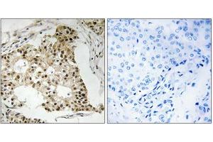 Immunohistochemical staining of paraffin-embedded human breast carcinoma tissue reacted with RARA (phospho S77) polyclonal antibody  at 1:50-1:100 dilution. (Retinoic Acid Receptor alpha antibody  (pSer77))