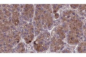 ABIN6273978 at 1/100 staining Human liver cancer tissue by IHC-P. (OR2L3/2L8 antibody)