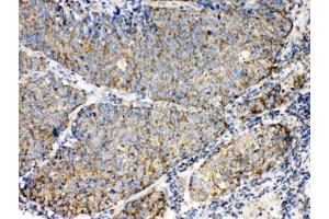 IHC testing of FFPE human lung cancer tissue with TECTA antibody at 1ug/ml. (TECTA antibody  (AA 93-134))