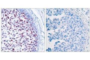 Immunohistochemical analysis of paraffin-embedded human breast carcinoma tissue using c-Jun(Phospho-Thr239) Antibody(left) or the same antibody preincubated with blocking peptide(right). (C-JUN antibody  (pThr239))