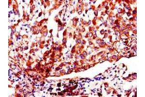 Immunohistochemistry of paraffin-embedded human lung cancer using ABIN7142915 at dilution of 1:100