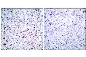 Immunohistochemical analysis of paraffin-embedded human breast carcinoma tissue using c-Jun (phospho- ser63) antibody (E011001). (C-JUN antibody  (pSer63))