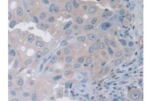 Detection of TRPV3 in Human Breast cancer Tissue using Polyclonal Antibody to Transient Receptor Potential Cation Channel Subfamily V, Member 3 (TRPV3)